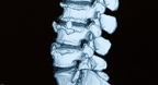 Next-Generation Disc Prosthesis Designed in Mathematica